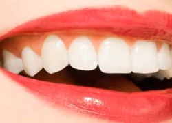 Normal_tanden_glimlach_lachen_gebit
